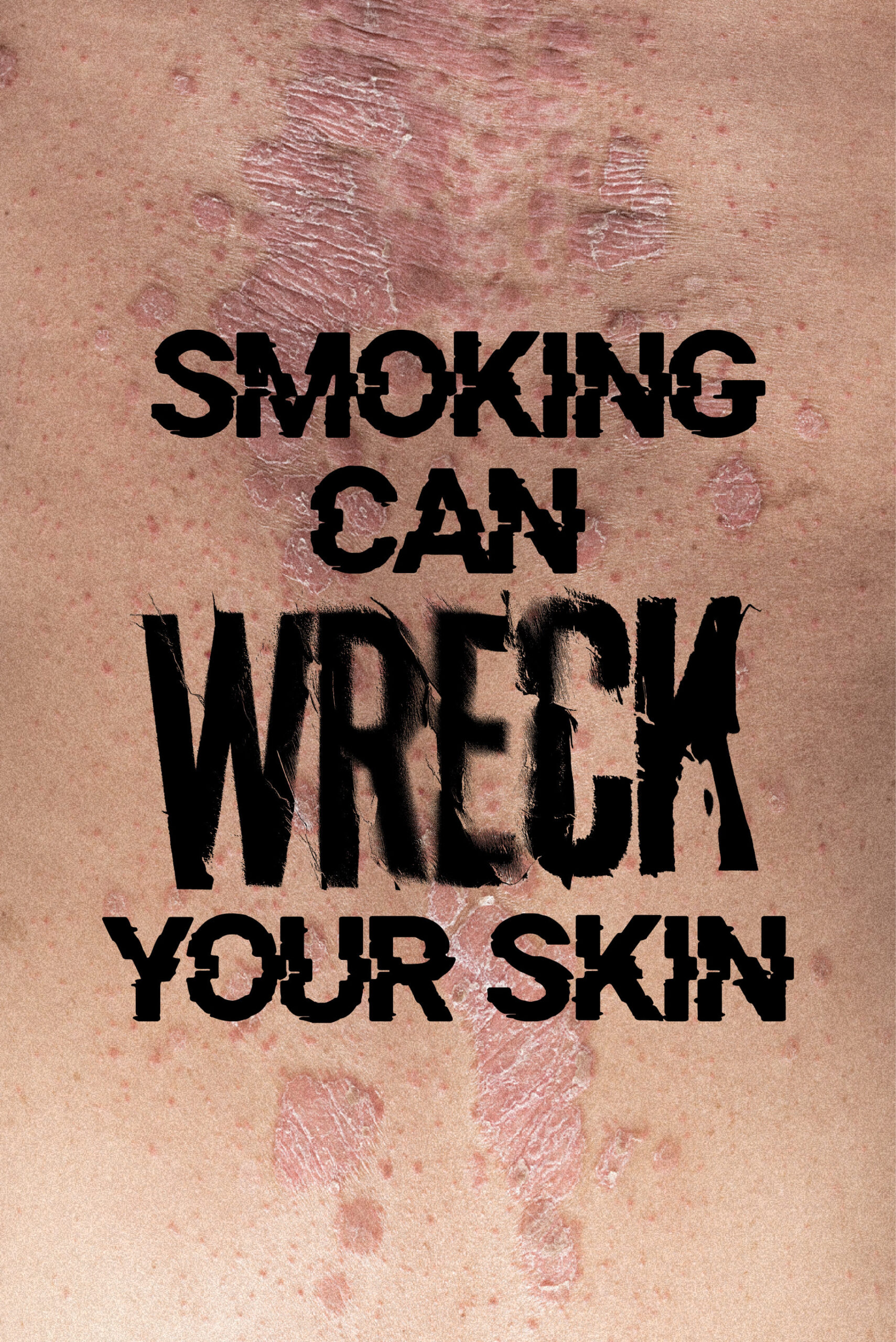 Smoking raises your risk of psoriasis, and even prevents treatments from working. 